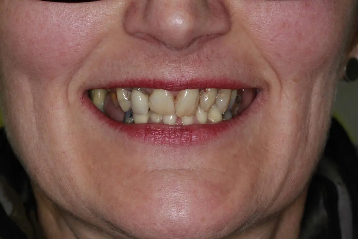 Avant - Prothèses fixes sur implants