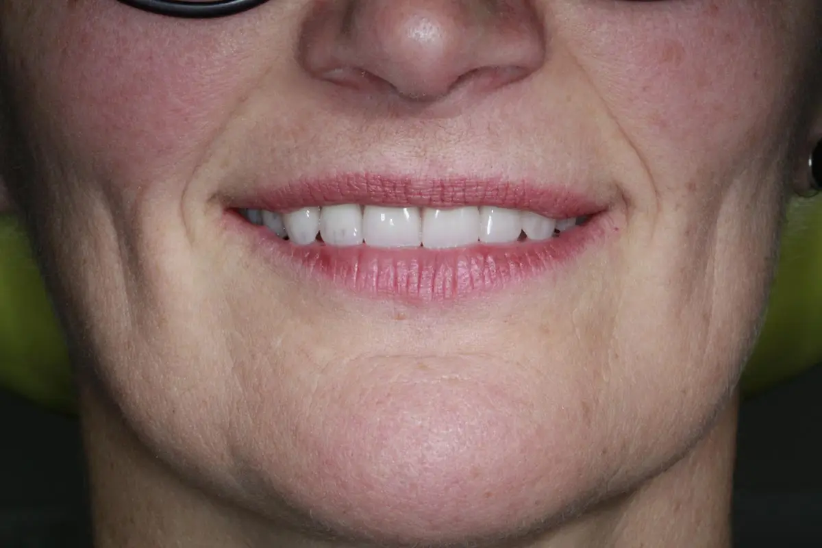 Après - Prothèses fixes sur implants