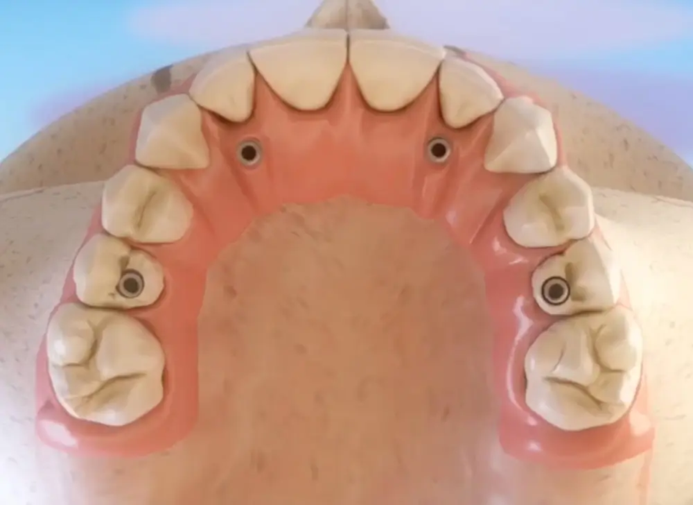 Prothèse fixe sur 4 implants - All-on-4